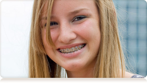 smiling girls with braces
